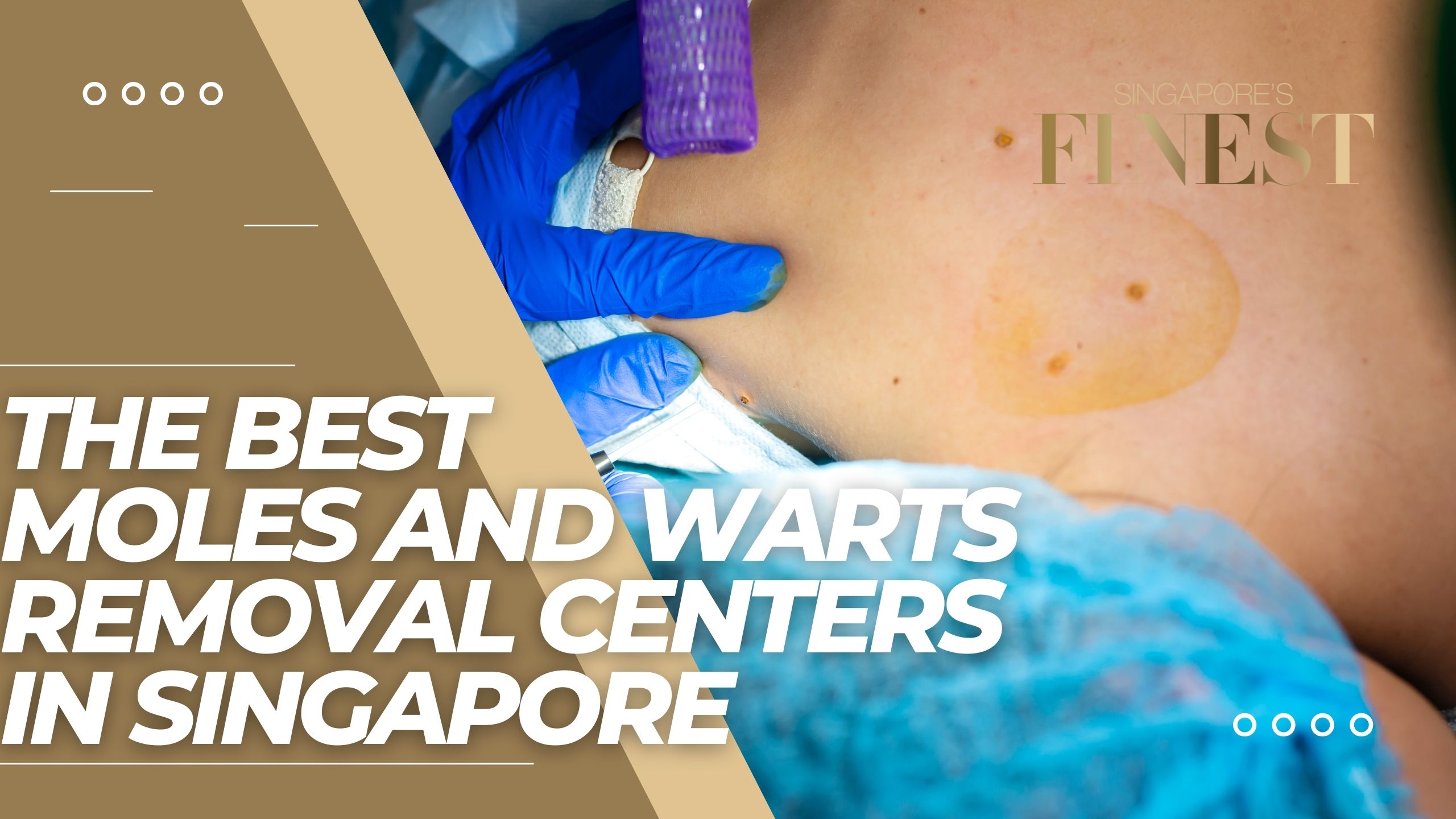 The Finest Moles and Warts Removal Centers in Singapore