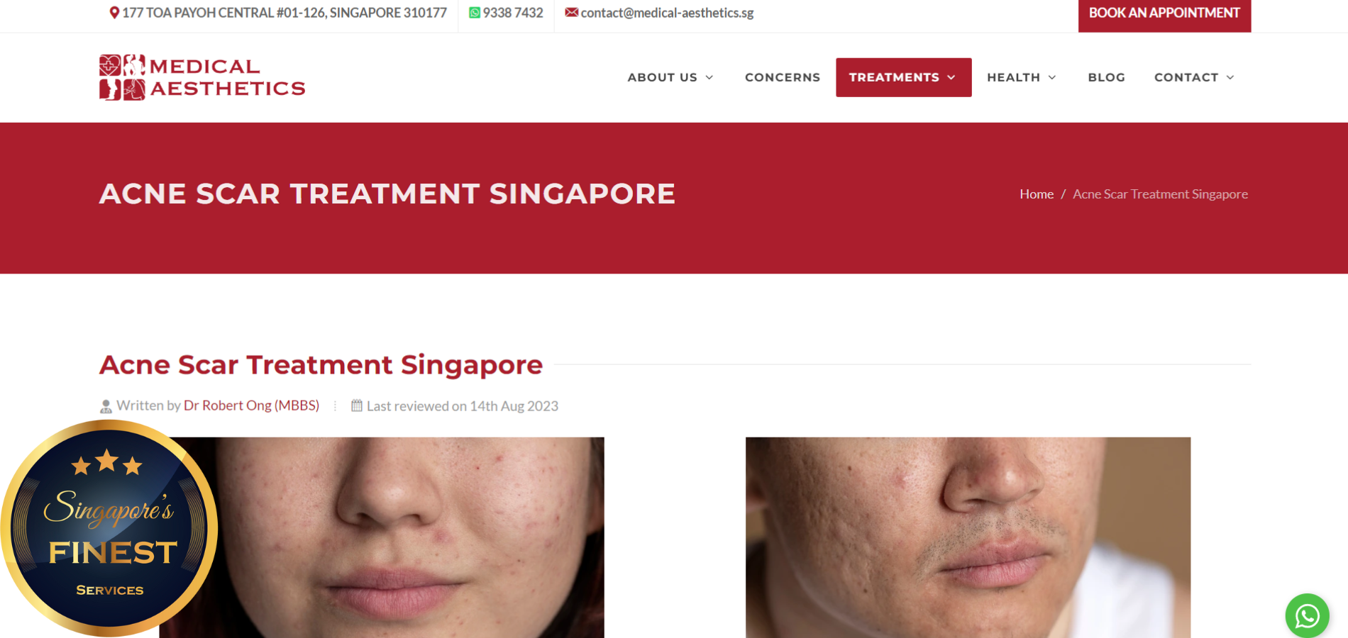 The Finest Clinics for Acne Scar Treatments in Singapore