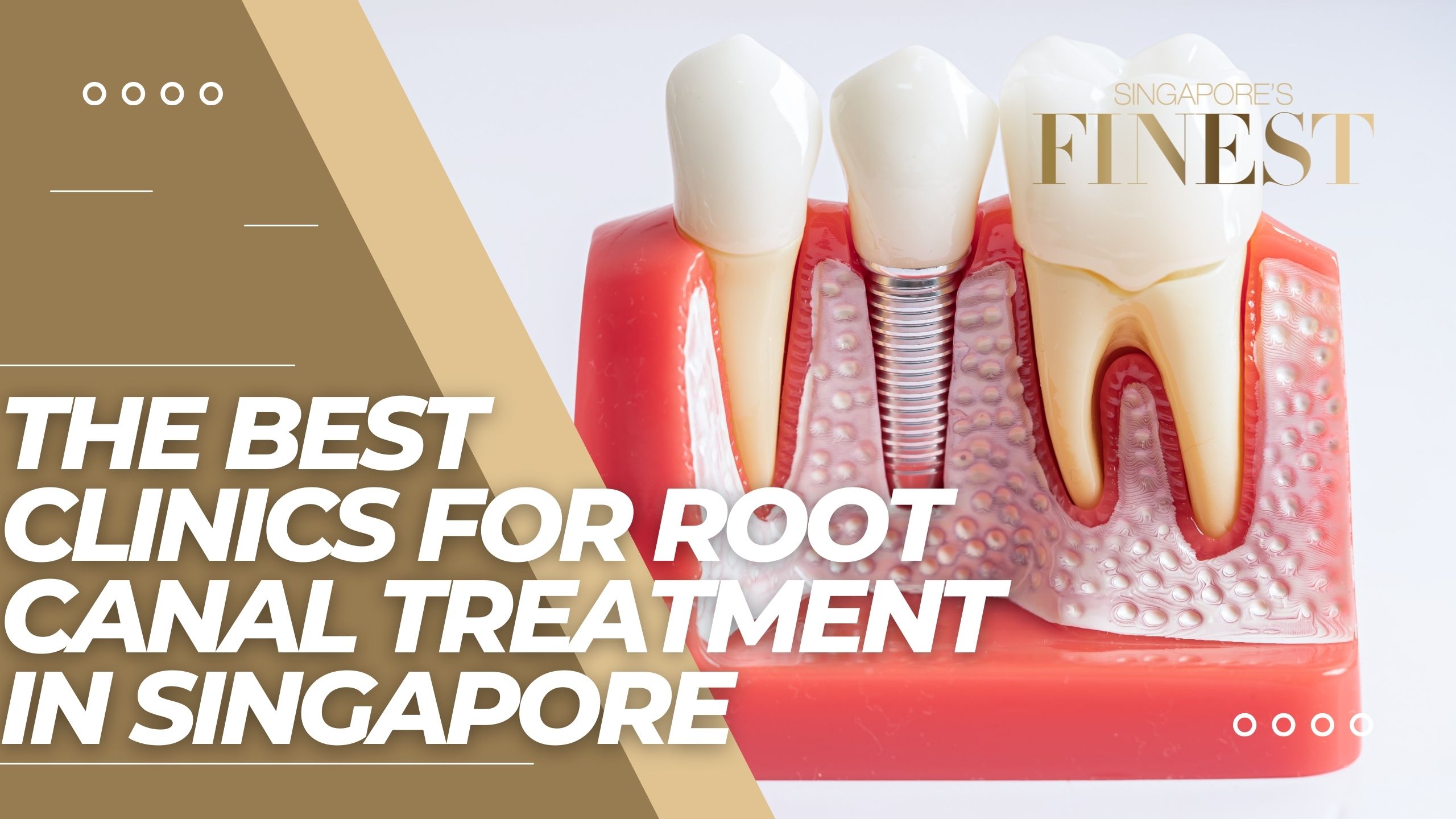The Finest Clinics for Root Canal Treatment in Singapore