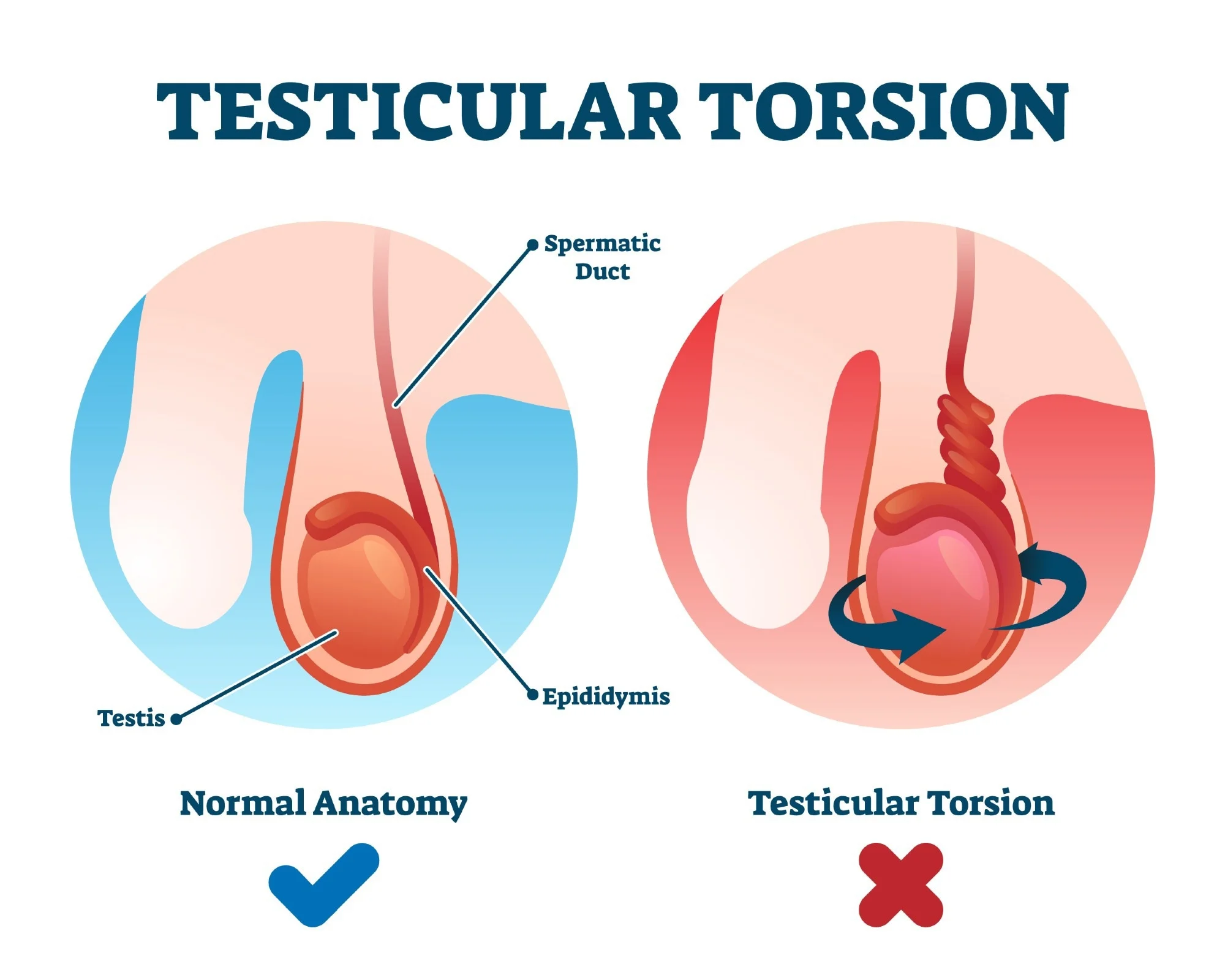 Testicular torsion: what is it? Is it possible for males to become infertile after they lose their testicles?