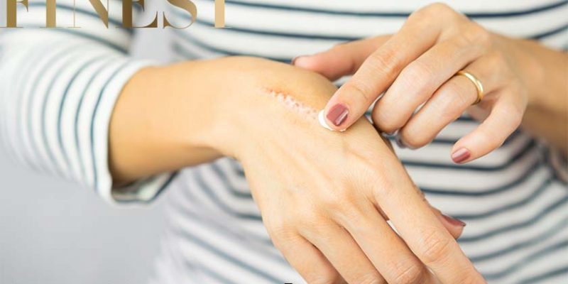 Top 5 Best Scar Removal Creams in Singapore